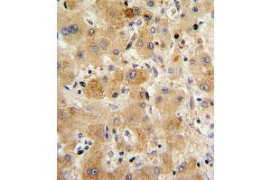 Formalin-fixed and paraffin-embedded human hepatocarcinoma with TTR Antibody (Center), which was peroxidase-conjugated to the secondary antibody, followed by DAB staining. (TTR anticorps  (AA 47-74))