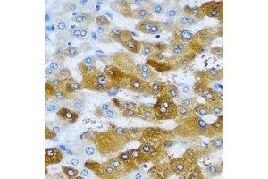 Immunohistochemical analysis of IMPA1 staining in human liver cancer formalin fixed paraffin embedded tissue section.