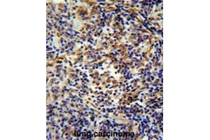 CASKIN2 antibody(Center) immunohistochemistry analysis in formalin fixed and paraffin embedded human lung carcinoma followed by peroxidase conjugation of the secondary antibody and DAB staining. (CASKIN2 anticorps  (Middle Region))