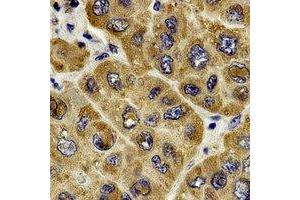 Immunohistochemical analysis of c-RAF staining in human liver cancer formalin fixed paraffin embedded tissue section. (RAF1 anticorps  (C-Term))
