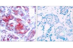 Immunohistochemistry analysis of paraffin-embedded human breast carcinoma, using STAT4 (Phospho-Tyr693) Antibody. (STAT4 anticorps  (pTyr693))