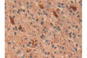 Detection of UCHL1 in Human Glioma Tissue using Polyclonal Antibody to Ubiquitin Carboxyl Terminal Hydrolase L1 (UCHL1)
