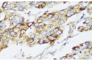 Immunohistochemistry of paraffin-embedded Human liver cancer using ECI2 Polyclonal Antibody at dilution of 1:150 (40x lens).