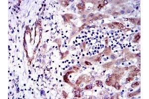 Immunohistochemical analysis of paraffin-embedded liver cancer tissues using GSTM1 mouse mAb with DAB staining.