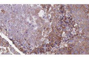 ABIN6276868 at 1/100 staining Human urothelial cancer tissue by IHC-P. (IFNAR2 anticorps)