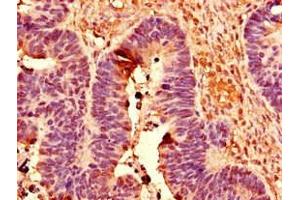 Immunohistochemistry of paraffin-embedded human ovarian cancer using ABIN7150430 at dilution of 1:100 (POLR2C anticorps  (AA 2-275))