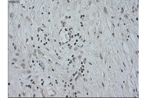 Immunohistochemical staining of paraffin-embedded Carcinoma of kidney tissue using anti-CTAG1Bmouse monoclonal antibody. (CTAG1B anticorps)