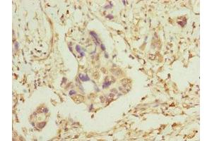 Immunohistochemistry of paraffin-embedded human pancreatic cancer using ABIN7159918 at dilution of 1:100