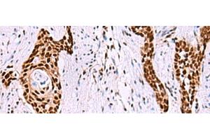 Immunohistochemistry of paraffin-embedded Human esophagus cancer tissue using ISY1-RAB43 Polyclonal Antibody at dilution of 1:55(x200) (ISY1-RAB43 Readthrough (ISY1-RAB43) anticorps)