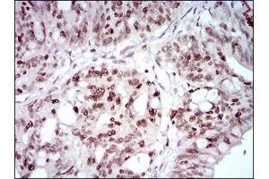 Immunohistochemical analysis of paraffin-embedded rectum cancer tissues using HOXB4 mouse mAb with DAB staining. (HOXB4 anticorps  (AA 16-251))