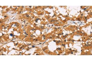 Immunohistochemistry of paraffin-embedded Human thyroid cancer tissue using CD22 Polyclonal Antibody at dilution 1:50 (CD22 anticorps)