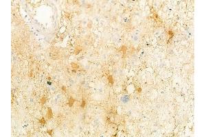 ABIN6261917 and ABIN6278468 at 1/100 staining human astrocytoma by IHC-P. (GUCY1A1 anticorps  (C-Term))
