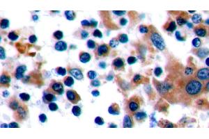 Detection of CTLA4 in Human Tonsil Tissue using Polyclonal Antibody to Cytotoxic T-Lymphocyte Associated Antigen 4 (CTLA4) (CTLA4 anticorps  (AA 52-211))