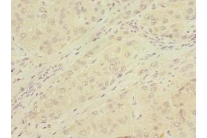 Immunohistochemistry of paraffin-embedded human liver cancer using ABIN7159068 at dilution of 1:100