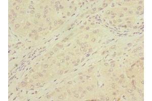 Immunohistochemistry of paraffin-embedded human liver cancer using ABIN7159068 at dilution of 1:100 (MMP19 anticorps  (AA 209-508))