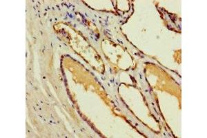 Immunohistochemistry of paraffin-embedded human prostate cancer using ABIN7148974 at dilution of 1:100 (CST11 anticorps  (AA 1-138))