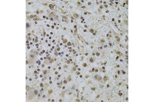 Immunohistochemistry of paraffin-embedded human liver cancer using INTS6 Antibody. (INTS6 anticorps  (AA 1-280))