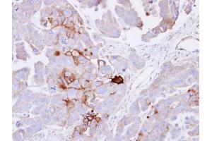 IHC-P Image Immunohistochemical analysis of paraffin-embedded OVCAR3 xenograft , using alkaline phosphatase (liver/bone/kidney), antibody at 1:100 dilution.