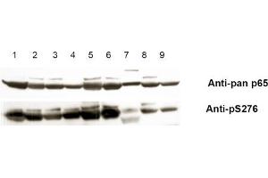 Anti-pS276 shows phospho p65 staining in carcinoma cells. (NF-kB p65 anticorps  (pSer276))