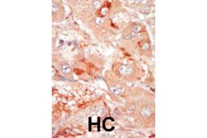 Formalin-fixed and paraffin-embedded human hepatocellular carcinoma tissue reacted with the PRPF4B polyclonal antibody , which was peroxidase-conjugated to the secondary antibody, followed by DAB staining. (PRPF4B anticorps  (C-Term))