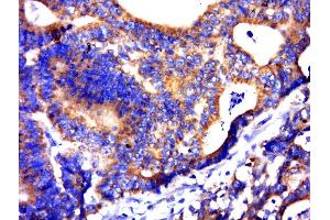 Paraformaldehyde-fixed, paraffin embedded human colon carcinoma, Antigen retrieval by boiling in sodium citrate buffer (pH6. (C21orf62 anticorps)