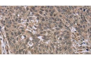 Immunohistochemistry of paraffin-embedded Human lung cancer tissue using IL15RA Polyclonal Antibody at dilution 1:45 (IL15RA anticorps)