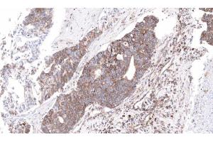 IHC-P Image Immunohistochemical analysis of paraffin-embedded human ovarian cancer, using NDUFS4, antibody at 1:100 dilution.