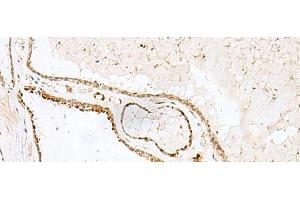 Immunohistochemistry of paraffin-embedded Human thyroid cancer tissue using GSKIP Polyclonal Antibody at dilution of 1:55(x200) (GSKIP anticorps)