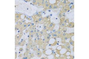 Immunohistochemistry of paraffin-embedded human liver injury using NDUFA7 antibody. (NDUFA7 anticorps  (AA 1-113))