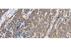 Immunohistochemistry of paraffin-embedded Human thyroid cancer tissue using ZNF410 Polyclonal Antibody at dilution of 1:40(x200) (ZNF410 anticorps)