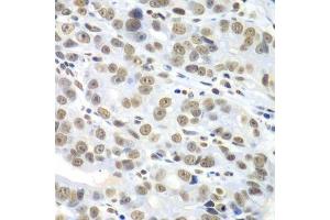 Immunohistochemistry of paraffin-embedded human gastric cancer using HDAC2 antibody. (HDAC2 anticorps  (C-Term))