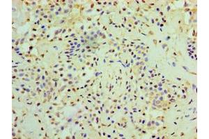 Immunohistochemistry of paraffin-embedded human breast cancer using ABIN7167634 at dilution of 1:100 (RMDN3 anticorps  (AA 1-470))