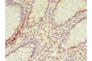 Immunohistochemistry of paraffin-embedded human colon cancer using ABIN7173091 at dilution of 1:100 (TMEM165 anticorps  (AA 173-228))