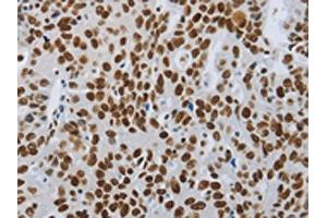 The image on the left is immunohistochemistry of paraffin-embedded Human ovarian cancer tissue using ABIN7192399(SLC16A14 Antibody) at dilution 1/80, on the right is treated with synthetic peptide. (SLC16A14 anticorps)