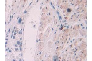 DAB staining on IHC-P; Samples: Human Stomach cancer Tissue