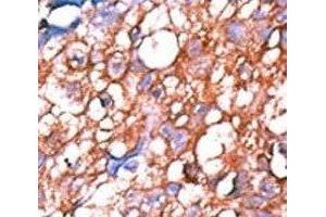 IHC analysis of FFPE human hepatocarcinoma tissue stained with the phospho-ERBB4 antibody.
