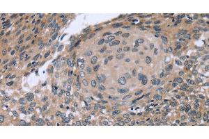 Immunohistochemistry of paraffin-embedded Human cervical cancer using p53RFP Polyclonal Antibody at dilution of 1:50 (RNF144B anticorps)