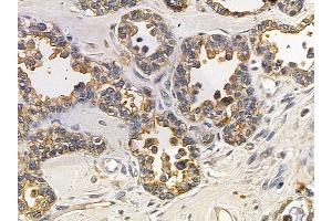 Annexin A2 Mouse Monoclonal Antibody at 1/100 staining human ovarian cancer by IHC-P.