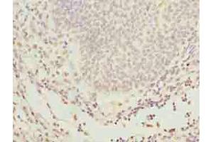 Immunohistochemistry of paraffin-embedded human bladder cancer using ABIN7154238 at dilution of 1:100 (GLT1D1 anticorps  (AA 17-152))