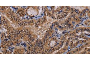 Immunohistochemistry of paraffin-embedded Human thyroid cancer using MCTS1 Polyclonal Antibody at dilution of 1:60 (MCTS1 anticorps)
