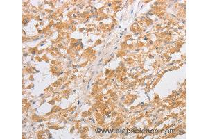 Immunohistochemistry of Human thyroid cancer using CDKN2AIP Polyclonal Antibody at dilution of 1:40 (CDKN2AIP anticorps)