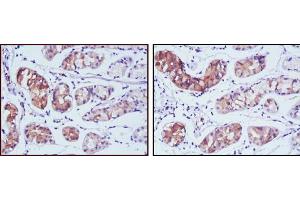 Immunohistochemical analysis of paraffin-embedded human stomach cancer tissues using PGA5 mouse mAb with DAB staining.