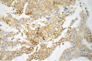 Immunohistochemistry was performed on paraffin-embedded human endometrial carcinoma using SRPK2 antibody (ABIN7800327), 1:200). (SRPK2 anticorps)