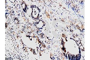 Formalin-fixed and paraffin embedded human colon carcinoma labeled with Anti-MMP-1 Polyclonal Antibody, Unconjugated (ABIN668931) at 1:200, followed by conjugation to the secondary antibody and DAB staining (MMP1 anticorps  (AA 401-464))