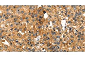 Immunohistochemistry of paraffin-embedded Human breast cancer tissue using SMYD4 Polyclonal Antibody at dilution 1:40 (SMYD4 anticorps)
