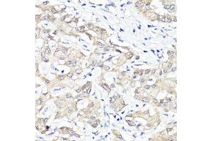 Immunohistochemistry of paraffin-embedded human liver cancer using YAP1 antibody.