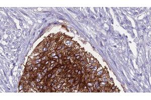 ABIN6276812 at 1/100 staining Human urothelial cancer tissue by IHC-P.