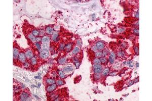 Anti-NTSR1 / NTR antibody IHC of human Lung, Adenocarcinoma.