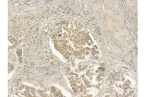 ABIN6258523 and ABIN6274745 at 1/100 staining human lung squamous cell carcinoma by IHC-P. (MRPL51 anticorps  (C-Term))