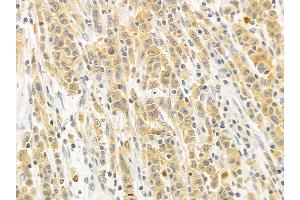 VASP Mouse Monoclonal Antibody at 1/100 staining human gastric cancer by IHC-P.